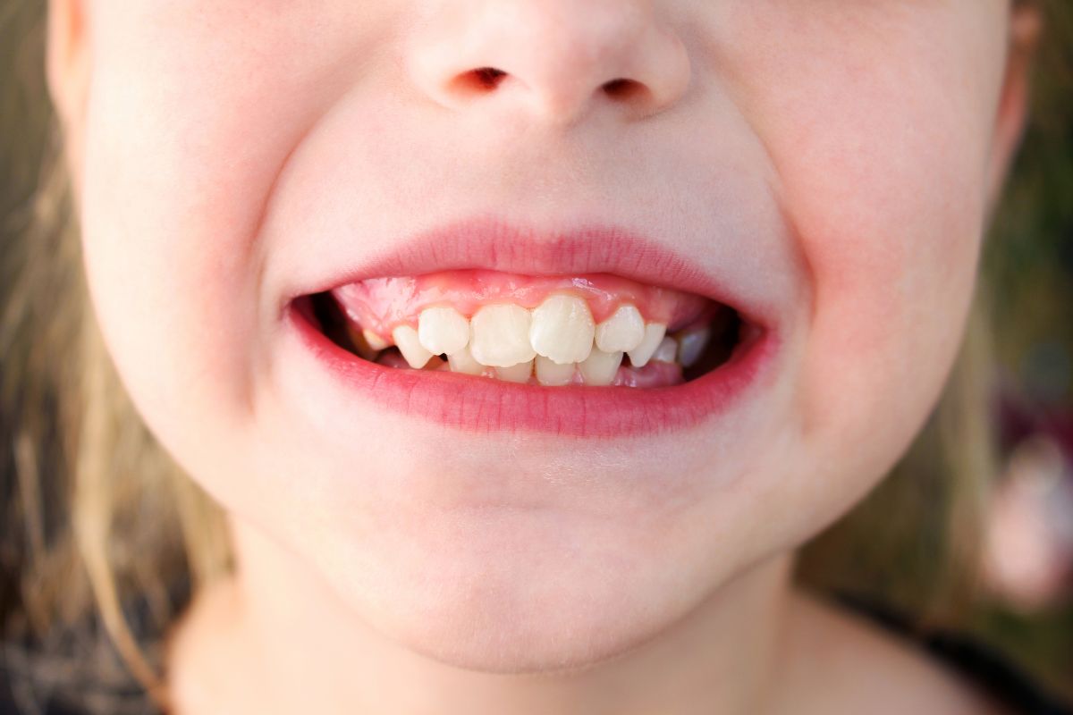 Crowded Baby Teeth