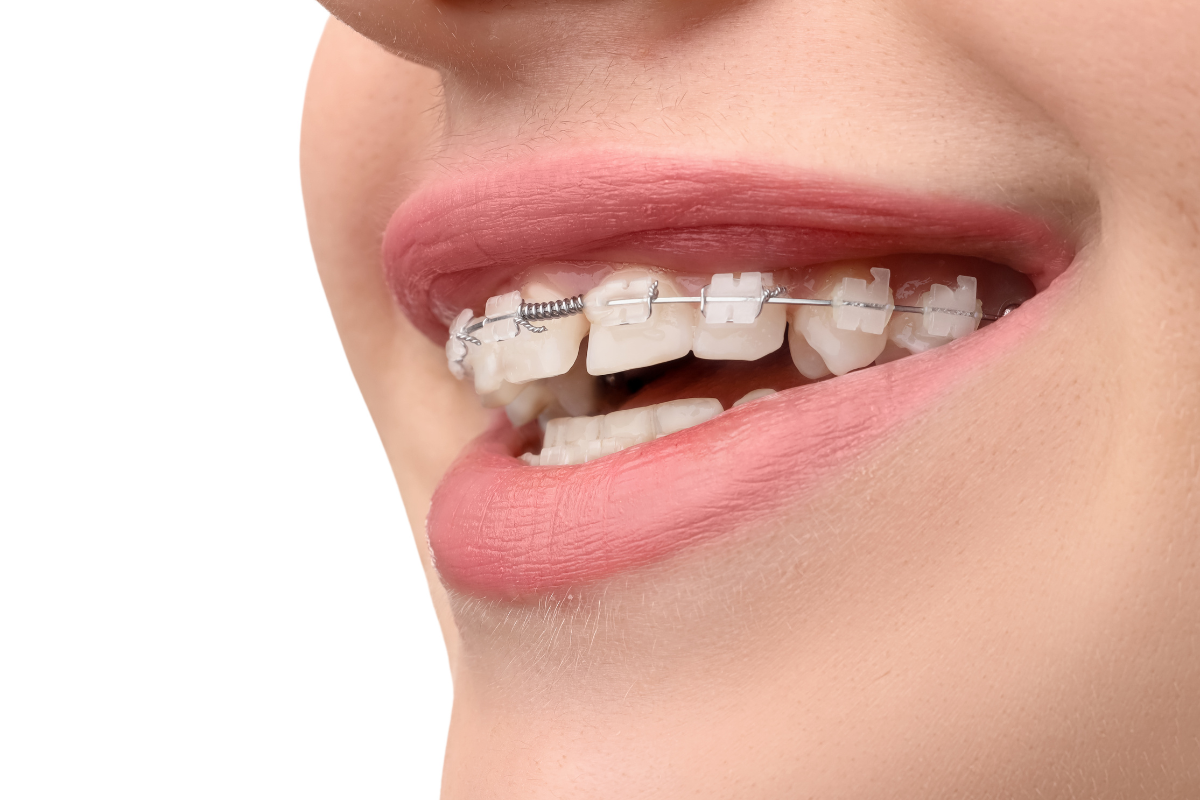 Braces