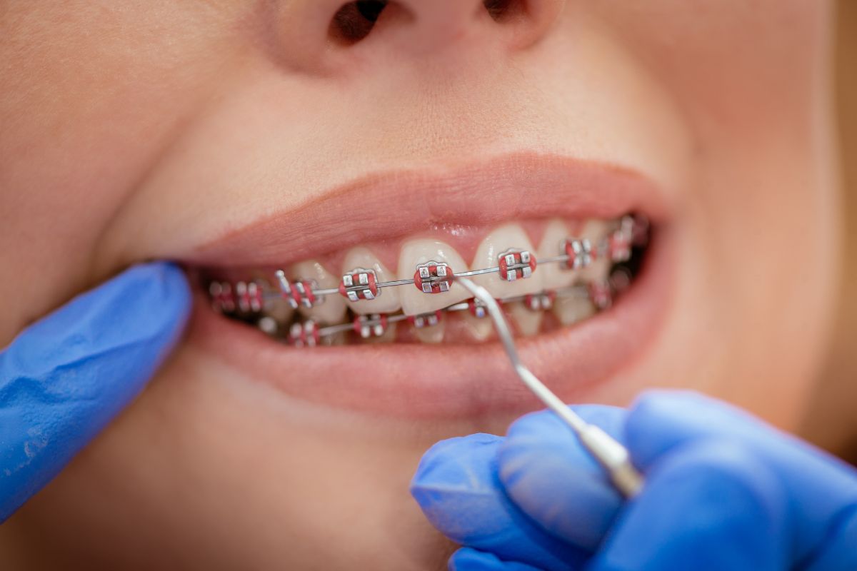 Does My Child Need Braces