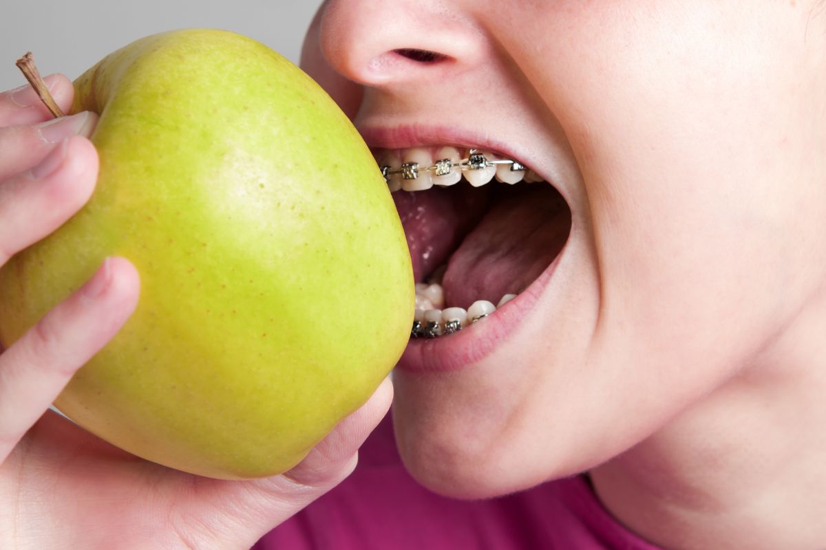 foods-to-avoid-with-braces-kid-friendly-guide-alpharetta