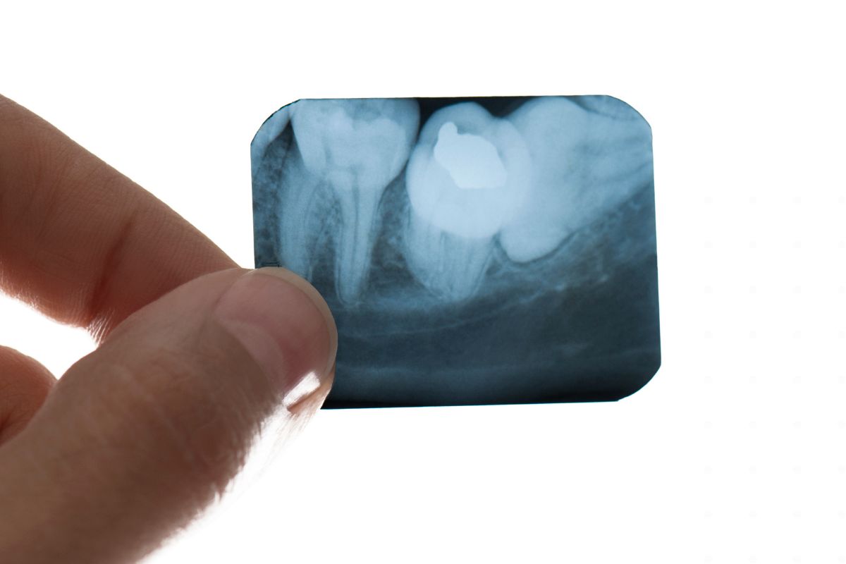 digital-x-rays-orthodontic-planning-kids