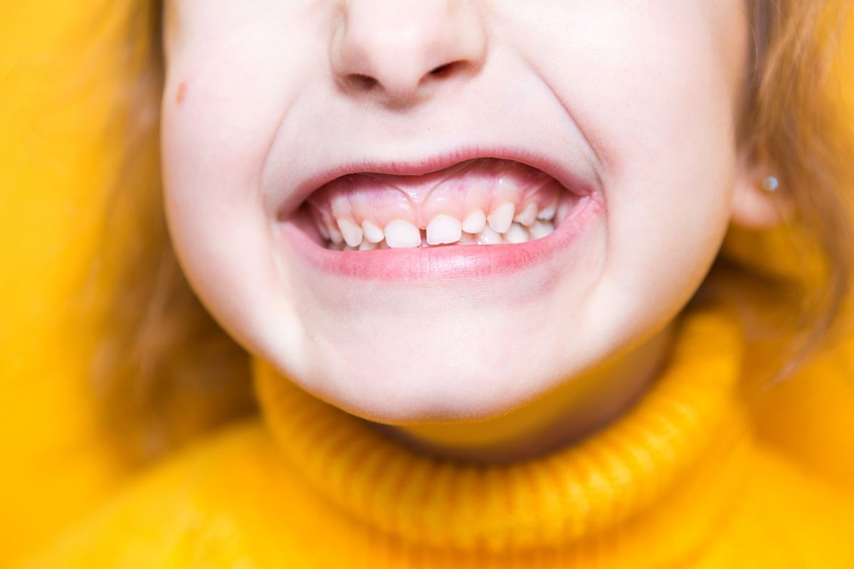 underbite-overbite-correction-children